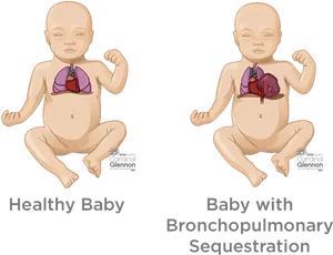 Healthy_vs_ Bronchopulmonary_ Sequstration_ Babies PNG