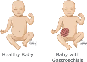 Healthyvs Gastroschisis Baby Comparison PNG