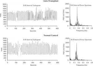 Heart Rate Variability Comparison Auto Transplantvs Normal Control PNG image