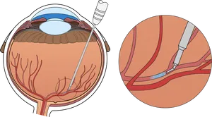 Intravitreal Injection Eye Treatment PNG image