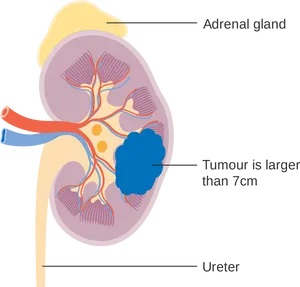 Kidney Anatomywith Tumor Illustration PNG image