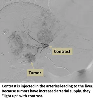 Liver Angiogram Tumor Detection PNG image