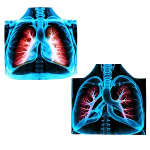 Lungs Under X-ray Png Lxm4 PNG image