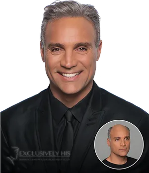 Mature Man Hair Restoration Transformation PNG image