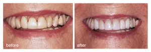 Teeth Whitening Before After PNG image