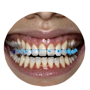 Teeth Whitening Procedure PNG 06262024 PNG