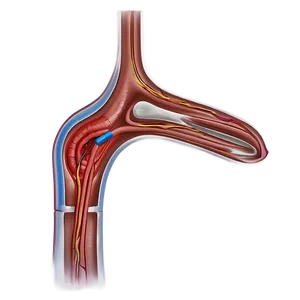 Vascular Surgery Procedure PNG Kyk57 PNG