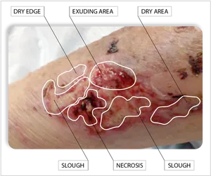 Wound Healing Stages Analysis PNG image